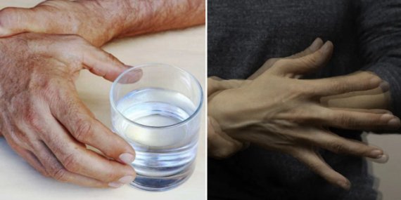 Parkinson hastaları dikkat: Bunları yemelisiniz?